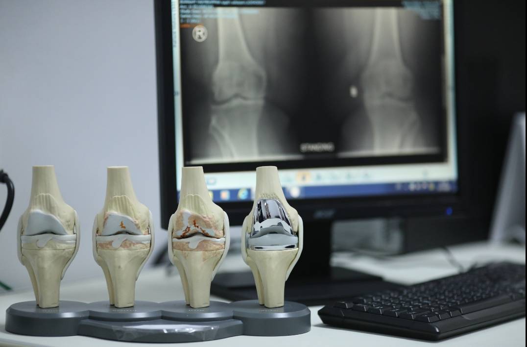 The UCS improves the lives of people living with knee pain